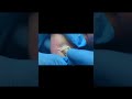 Professional ingrown toenail trimming~ #pedicure