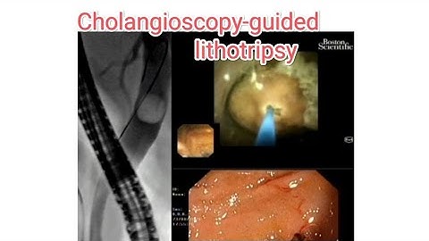 #:Cholangioscopy-guided lithotripsy . # Large CBD stone. # laser lithotripsy. # cholangioscopy