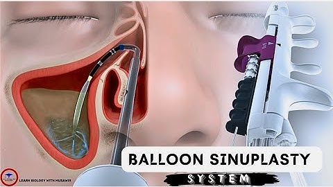 Balloon Sinuplasty System _ Medical video _