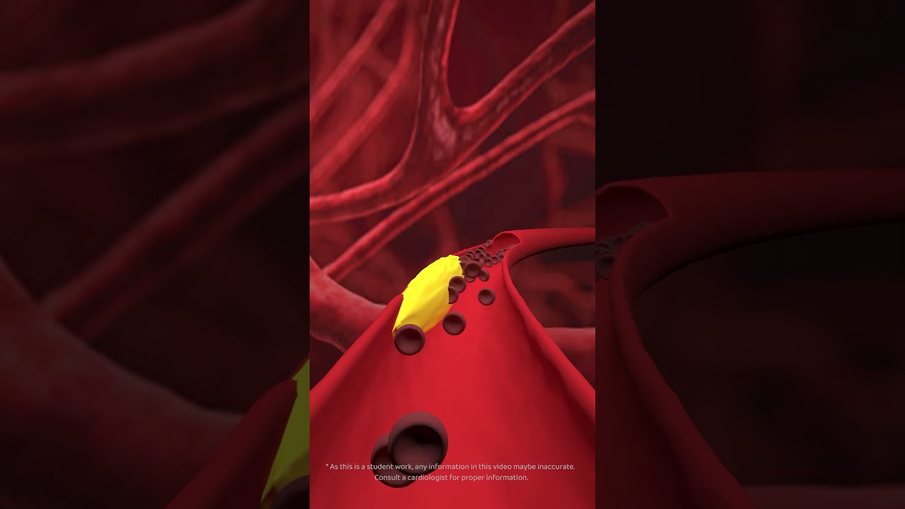 Coronary Angioplasty  3D Animation