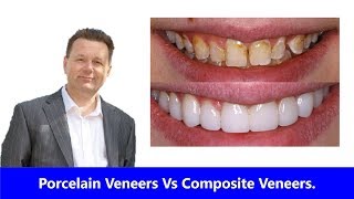 Porcelain Veneers Vs Composite Veneers. Which is Best?