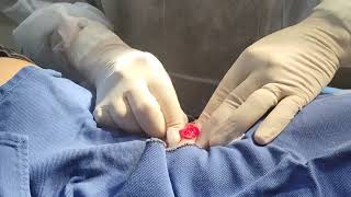 Lipoma excision in the abdomen