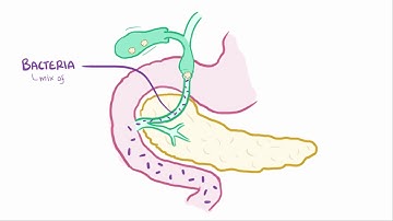 Ascending cholangitis acute cholangitis   causes, symptoms, diagnosis, & pathology