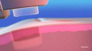 Portrait® Plasma Skin Regeneration technology from Energist Group