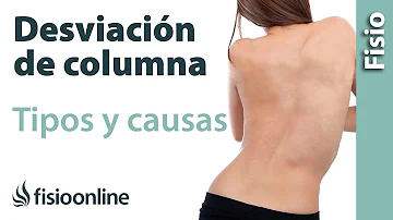 ¿Es grave la desalineación de la columna vertebral?