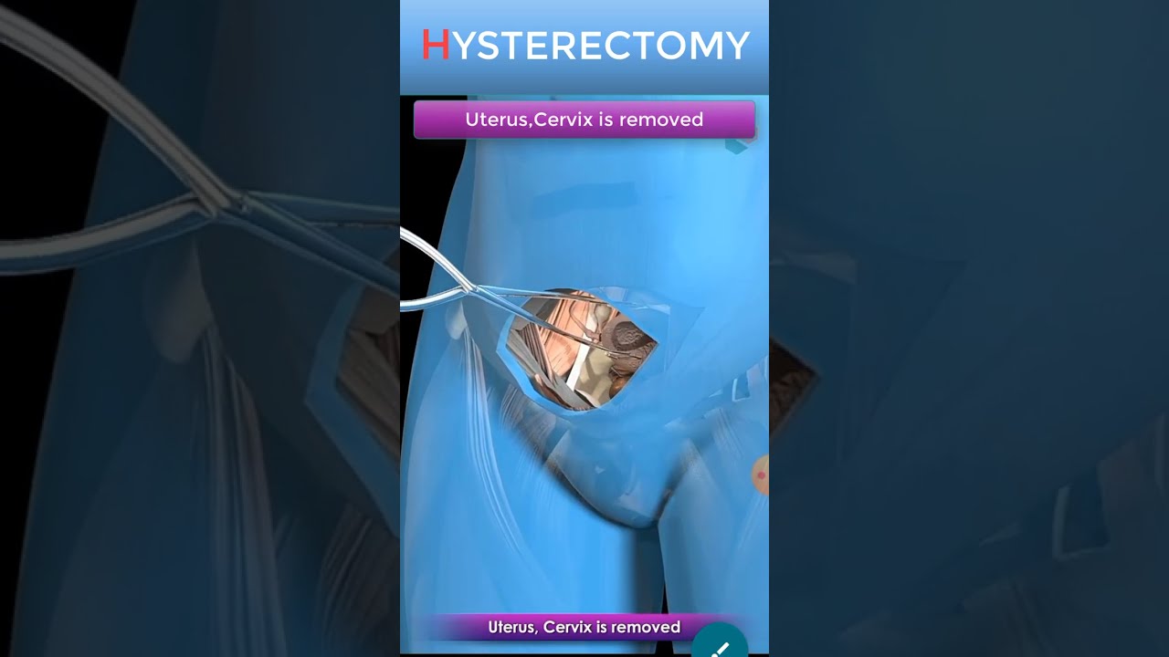 Abdominal Hysterectomy Procedure Short View Shorts