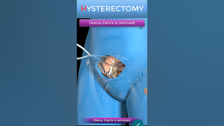 Abdominal Hysterectomy Procedure Short view #shorts
