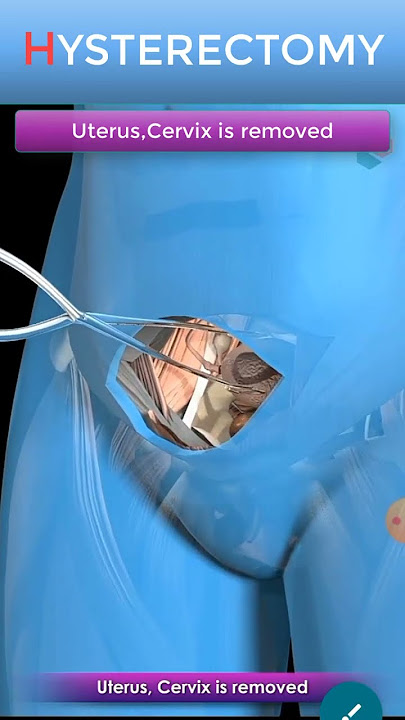 Abdominal Hysterectomy Procedure Short view #shorts