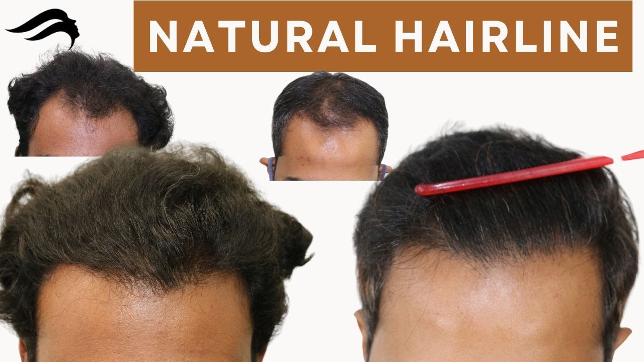 Hair Transplant In Chennai Cost Best, Cost & Results Of Hair Transplant In Chennai YouTube