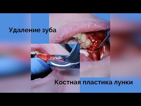 Удаление зуба и костная пластика – подготовка кости к имплантации