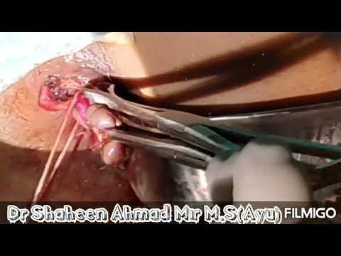 Ksharsutra Therapy In Grade Iv Interno External Haemorrhoid Under LA By Dr Shaheen Ahmad Mir