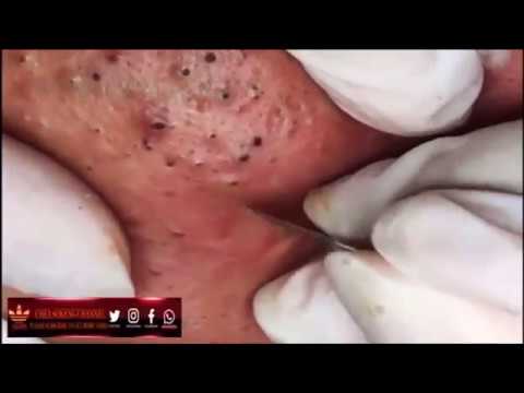 Video: Acne: come combattere i punti neri