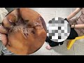 😱🦶 Jigger Gigante Extraído – Limpeza Completa dos Pés! #VY014