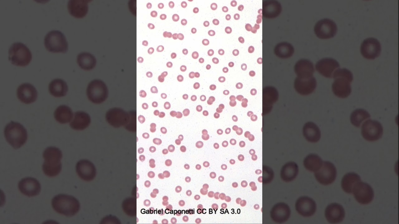Rouleaux Formation vs. Agglutination - NEET PG/NEXT PG Guide : Mastering Pathology