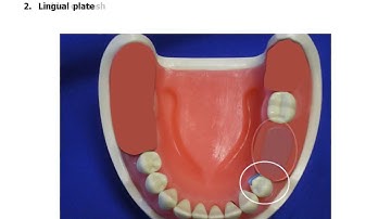 Kennedy Class II Modification 1 Design Template