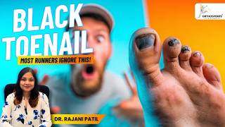 Black Toenail From Running: How to Prevent It Fast |Most Runners Ignore This!| Dr. Rajani Patil