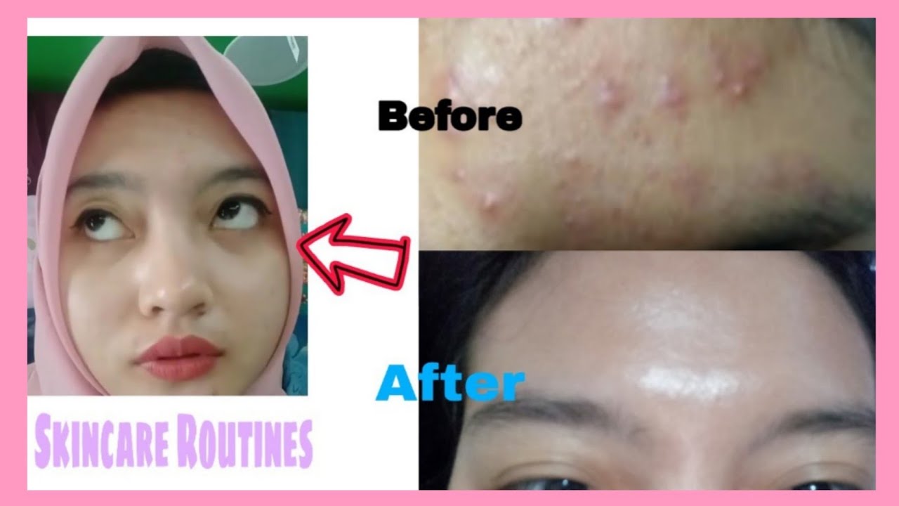 SKINCARE AMPUH HILANGKAN JERAWAT BRUNTUSAN - YouTube