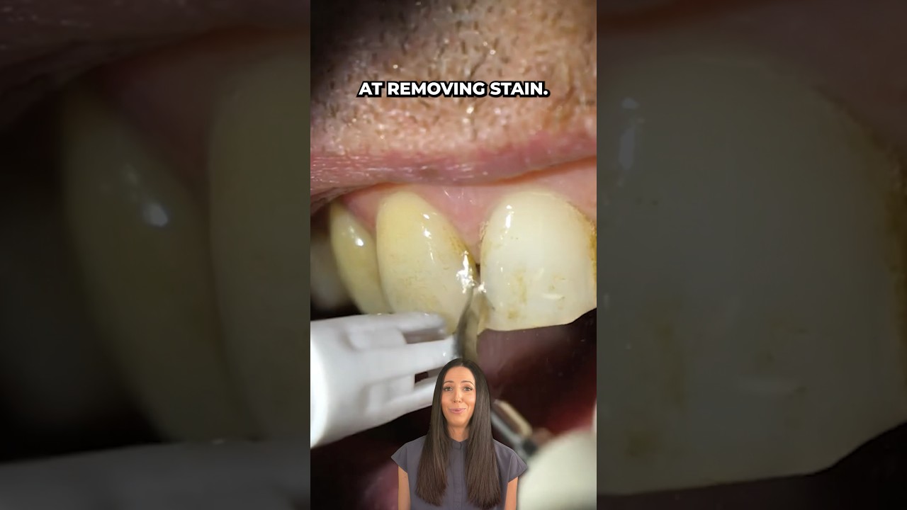 smoker’s teeth cleaning 