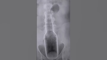 ☢️foreign bodies radiation city#shorts #radiological #hospital #radiology #radiation #virlvdeo #xray