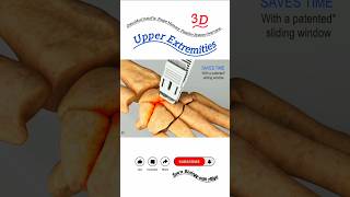 OsteoMed InstaFix Shape Memory Fixation System Overview - Upper Extremities #3d #shorts