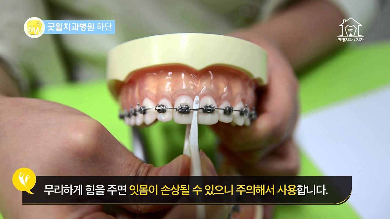굿윌치과병원] 교정용 치실 사용설명 영상 - Youtube