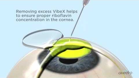 LASIK with Collagen Cross linking or LASIK Xtra