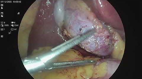 cholecystectomie coelioscopique