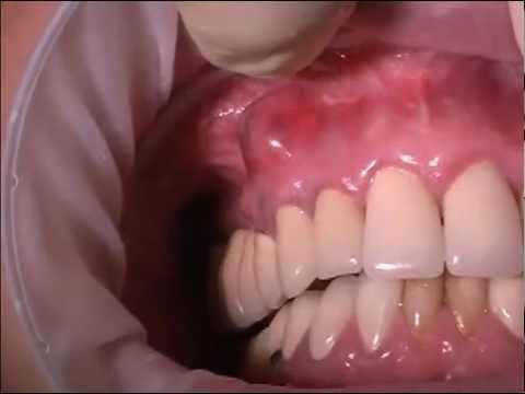 Video: L'ascesso scompare dopo l'estrazione del dente?