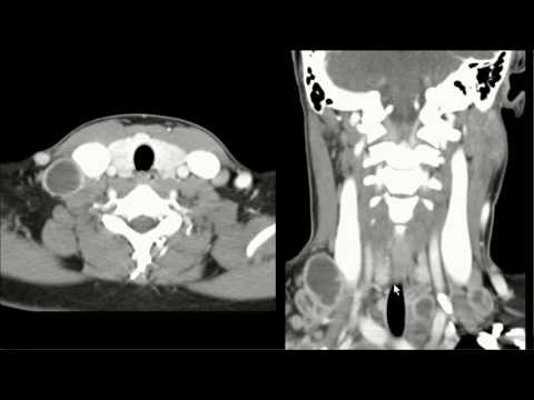 Linfadenite tuberculosa / Tuberculous lymphadenitis