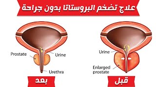 علاج التهاب البروستاتا نهائيا بدون ادوية أعشاب لعلاج لتضخم البروستاتا التخلص من مشاكل التبول فى أيام