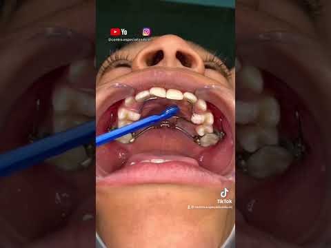 Video: ¿Un expansor te rompe la mandíbula?