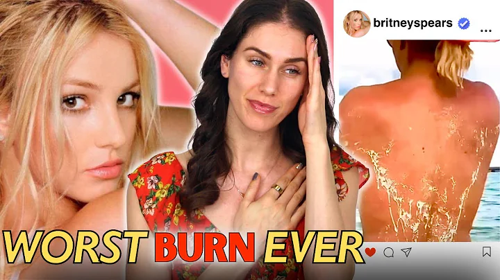 Britney Spears Got The Worst Celebrity Sunburn Ive...