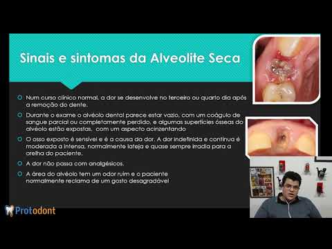 Vídeo: Alveolite - Sintomas, Tratamento, Complicações, Alveolite Pulmonar