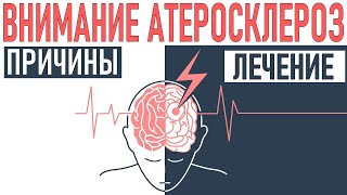 АТЕРОСКЛЕРОЗ СОСУДОВ ГОЛОВНОГО МОЗГА