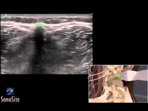 3d how to ultrasound guided lumbar puncture procedure lumbar spine