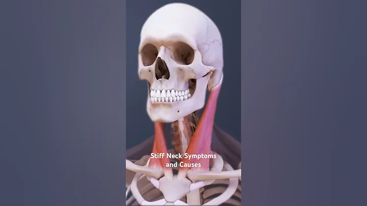 Stiff Neck Symptoms and Causes