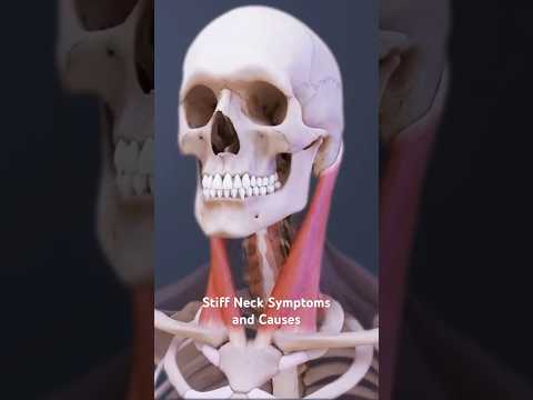 Stiff Neck Symptoms