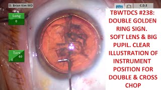 TBWTDCS #238: Double Golden Ring Sign? Big Pupil. Soft Lens. Clear View of Instrument Positioning.