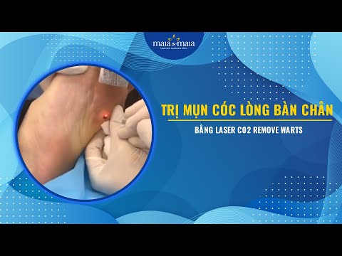 Trị mụn cóc lòng bàn chân bằng Laser C02 remove warts