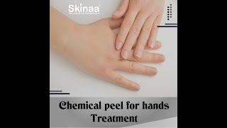 Chemical Peel For Hands Treatment At Skinaa Clinic Viral 