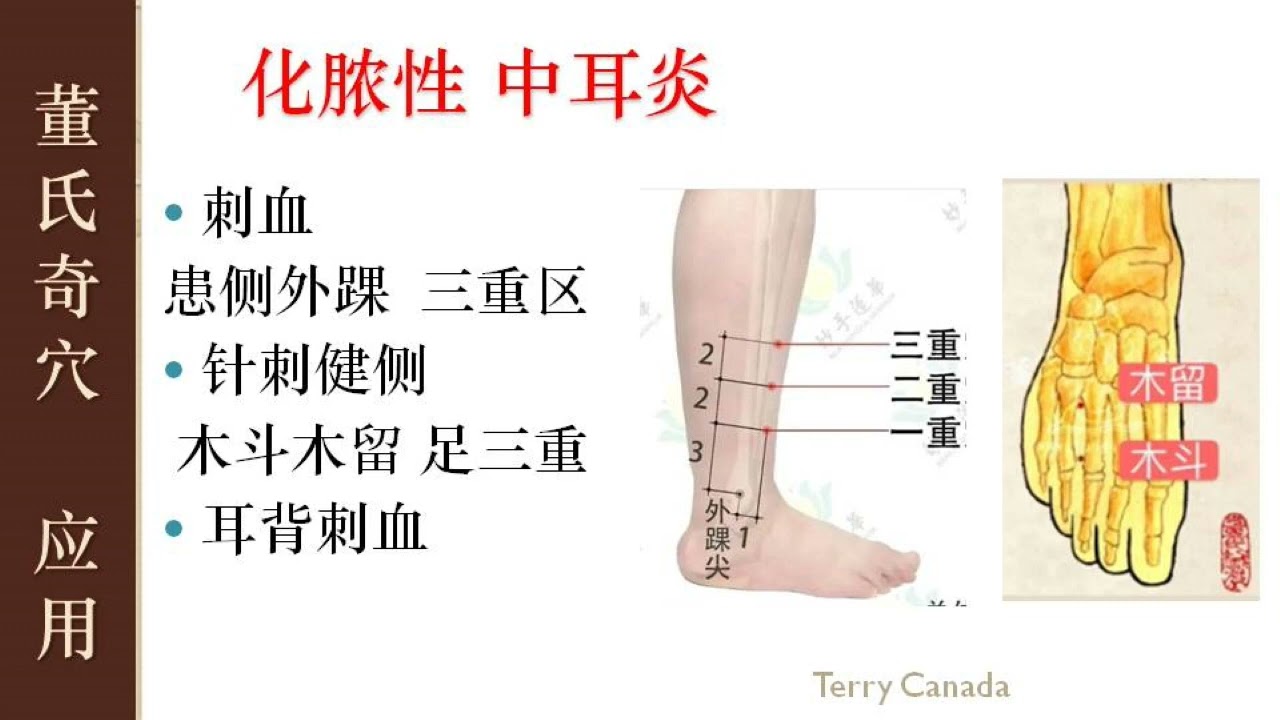 3 31 化脓性中耳炎 董氏奇穴 林君 Master Tung Acupuncture Points Youtube