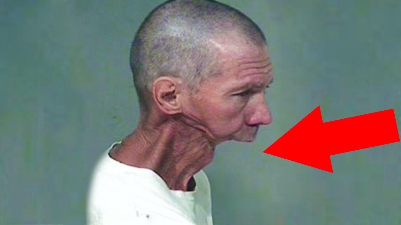 Krokodil Droge Vorher Nachher Bilder
