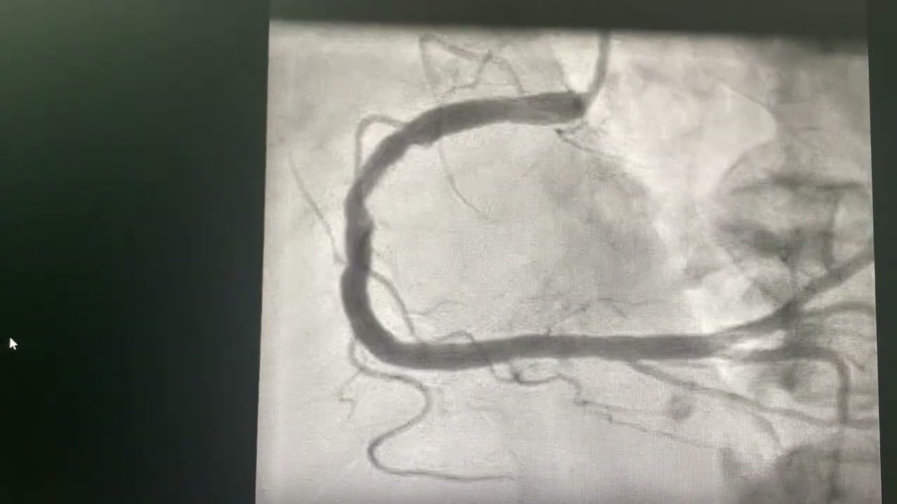 IVUS guided Left main coronary Intervention