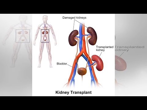 Przeszczep nerki