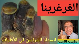 مرض انسداد الشرايين للاطراف و الغرغرينا