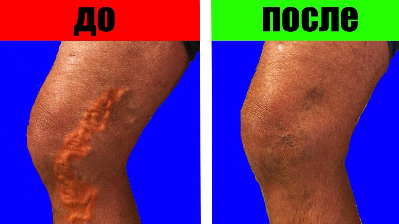 Как я вылечила варикоз | Копеечное средство при варикозе - YouTube