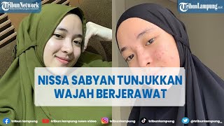 Nissa Sabyan Tunjukkan Wajah Berjerawat saat Selfie Tak Make Up
