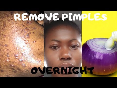 How To Remove Pimples Overnight | Acne Treatment | With Onions
