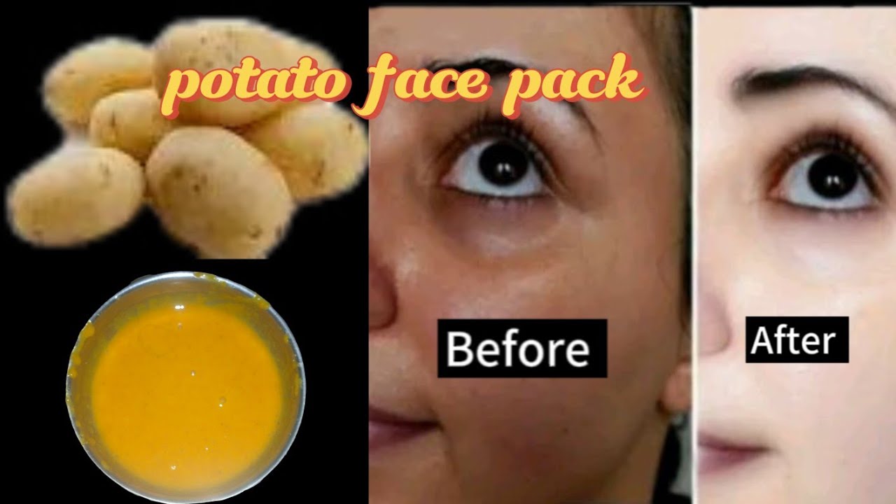 Potato face pack for glowing skin , pigmentation' Acne scars , Melasma