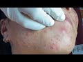 Huong Da Nang Acne Treatment #289